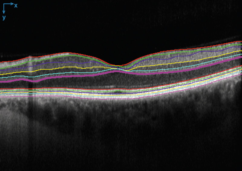 Deep Learning-Based Retinal Layer Segmentation in Optical Coherence Tomography Scans of Patients with Inherited Retinal Diseases.