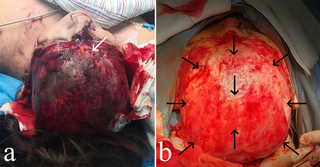 Treatment of severe scalp avulsion injury through microsurgical vascular anastomosis, subarea multi-tubenegative pressure drainage, and anchoring sutures: a case report.