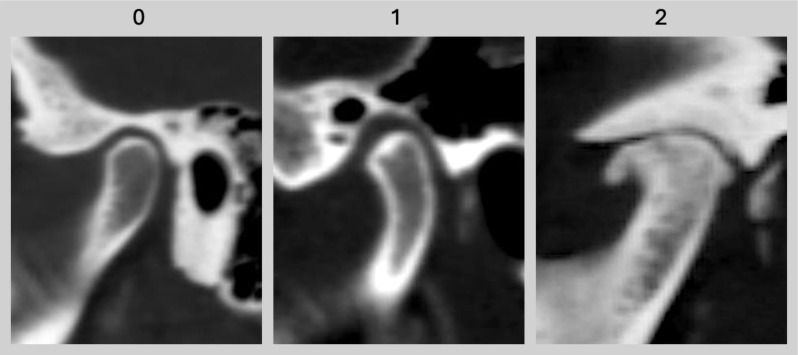 Dual-energy computed tomography collagen density mapping of the temporomandibular disc.