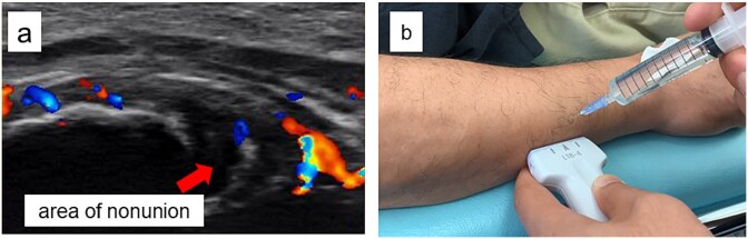 Bone union achieved in an ulnar shaft nonunion using dextrose prolotherapy without surgery: a case report.