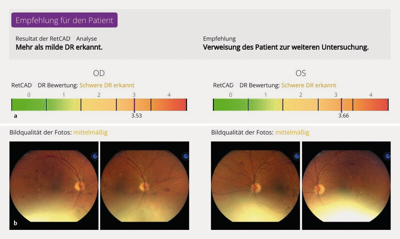 Automated Diabetic Retinopathy Screening in Out-patient Diabetes Care - Comparison of Two Artificial Intelligence Algorithms: RetCAD and OphtAI.