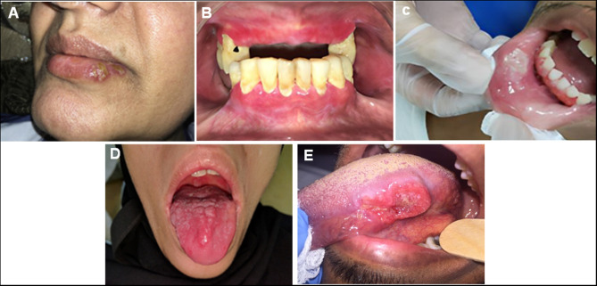 Initial Management Strategies for Oral Mucosal Lesions Among Local Pharmacists in Saudi Arabia: A Cross-Sectional Study.