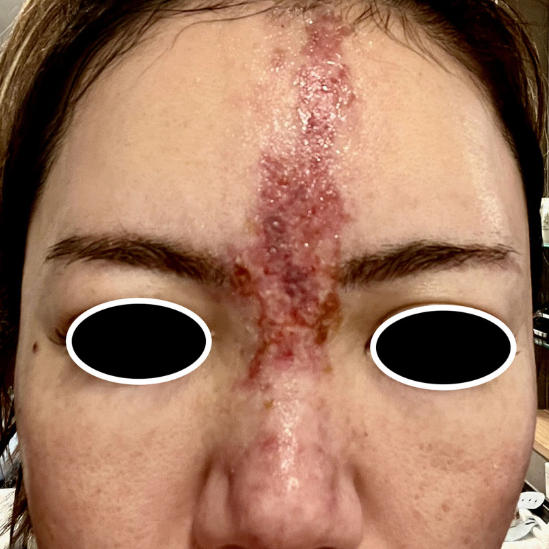 Late Intervention Yet Successful Outcome with High-dose Pulsed Hyaluronidase for Forehead Filler Vascular Complication.