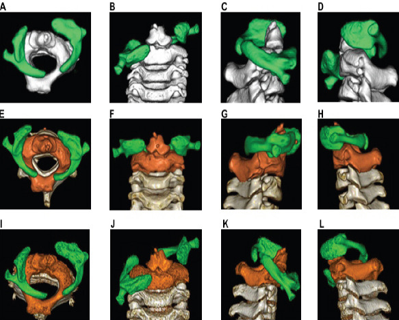 A Case of Atlanto-Axial Rotatory Fixation Requiring Internal Fixation.