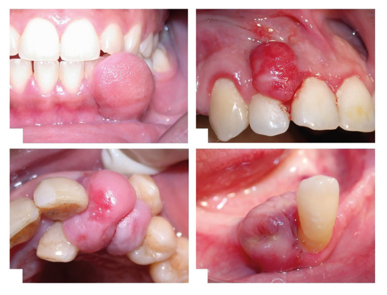 Epulis: A Narrative Review of Epidemiology, Clinical Features, Pathogenesis, and Management.