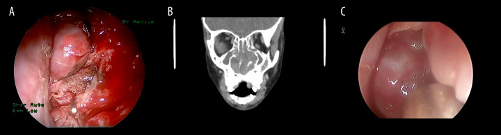 Retrospective Study of Pediatric Sinonasal Tumors in a Tertiary Hospital Setting.
