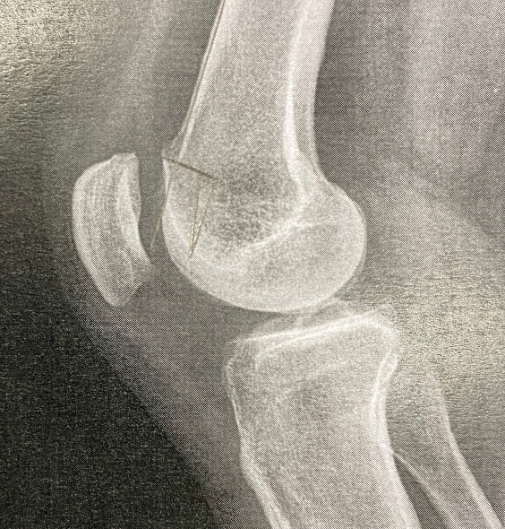 Chronic Flexion Patellar Dislocation with Femoral Patellofemoral Dysplasia and Anterior Bump: Treated by Distal Femoral Subtraction Osteotomy and Medial Patellofemoral Ligament Reconstruction - A Case Report.