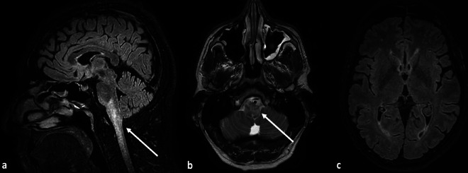 Neuroimaging in PRES: Isolated Brainstem and Spinal Cord Involvement Secondary to Aorto-Iliac Occlusive Disease-A Unique Case Report.