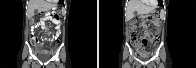 Peritonectomy for disseminated peritoneal implantation after dermoid cyst spillage causing recurrent peritonitis and xanthogranulomatous reaction: a case report.