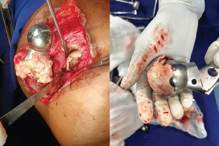 The Price of Poor Cementing: A Case Report on Chronic Hip Dislocation and Revision.