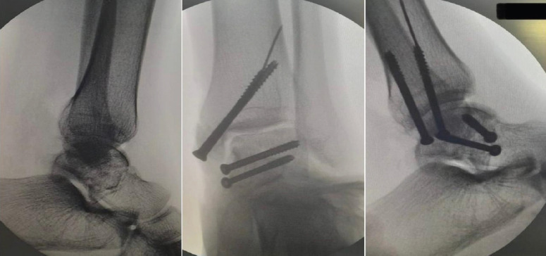 A Rare Case of Talus Neck and Open Medial Malleolus Fractures with Ankle Subluxation Treated using a Single Anteromedial Approach.