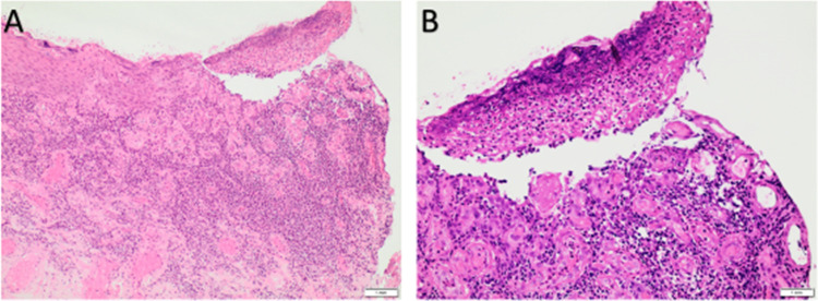 Balanitis Circumscripta Plasmacellularis in a Young Circumcised Male: A Case Report.