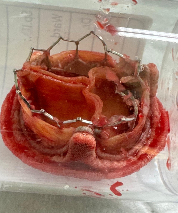 Successful Aortic Valve Replacement After Transcatheter Aortic Valve Implantation (TAVI) Following Initial Surgical Aortic Valve Replacement (SAVR): A Case Report.