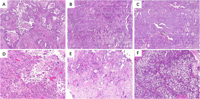 SMARCA2 Deficiency While Preserving SMARCA4 in Lung Adenocarcinoma Combined with Abnormal β-Catenin Expression.