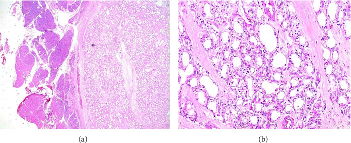 Solid Serous Cystadenoma Mimicking Neuroendocrine Tumor of the Pancreas: A Case Report.