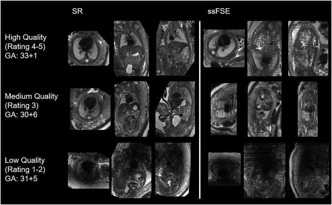 Lung volume segmentation in fetal MRI: super-resolution reconstructions improve inter-rater reliability.