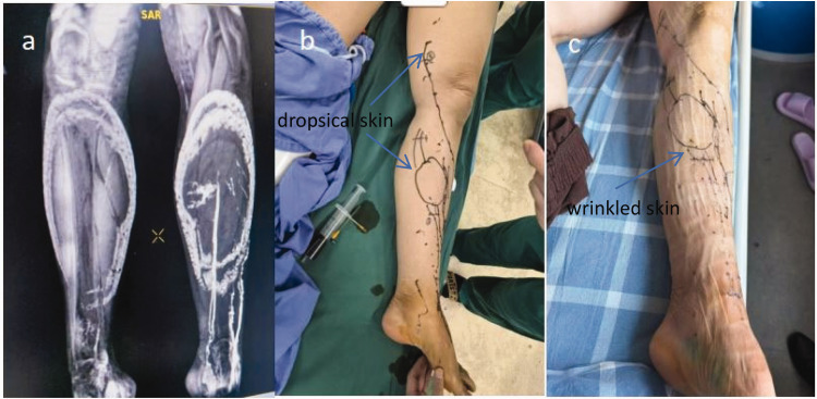 Multiple injections of indocyanine green for improving the outcomes of lymphatic-venous anastomosis reconstruction of lymphatic return under microscopy: A case report.