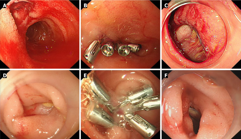 Complications of single-balloon enteroscopy: A nine-year multicenter experience of 2865 procedures.