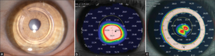 A comparative study of two intrastromal corneal ring segment models in keratoconus: A retrospective study.