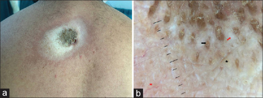 Extragenital Lichen Sclerosus - Morphea Overlap within the Same Lesion: A Rare Occurrence.