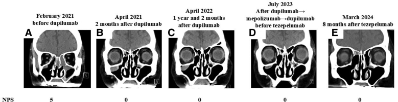 Successful switch to tezepelumab for severe asthma and chronic rhinosinusitis with nasal polyps.