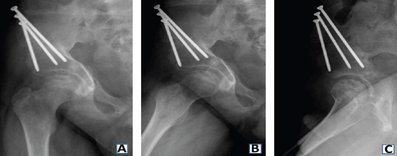 Developmental Hip Dysplasia Presenting as Bilateral Osteochondritis Dissecans Perthes-like Lesions Treated with Triple Pelvic Osteotomies: A Case Report.