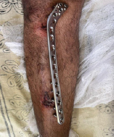 Low Profile, High Impact: External Fixation using Locking Plates in Challenging Tibial Fractures.