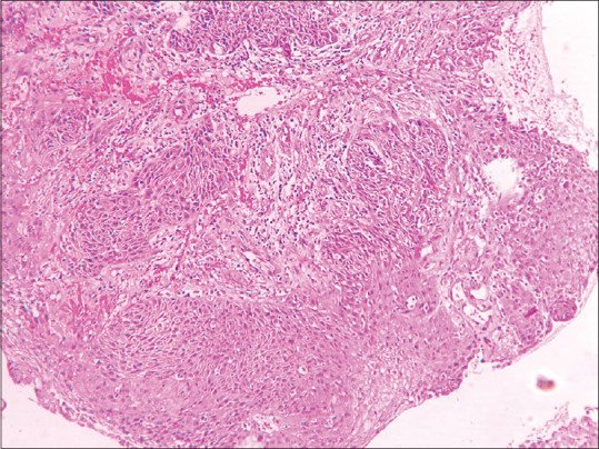 Huriez Syndrome.