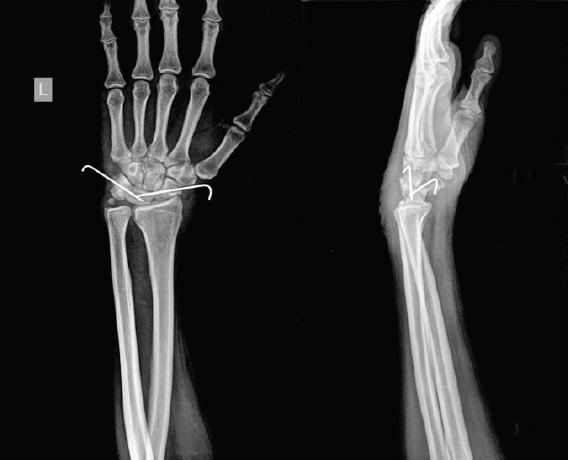 Neglected Isolated Lunate Dislocation in a Polytrauma Patient Presenting as Acute Carpal Tunnel Syndrome - A Case Report with Review of Literature.