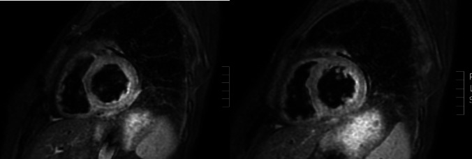 Simultaneous onset of systemic sclerosis and light chain amyloidosis: the first report of a case report and review of the literature.