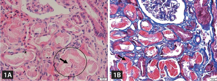 Findings suggestive of Fanconi syndrome and multiple myeloma.