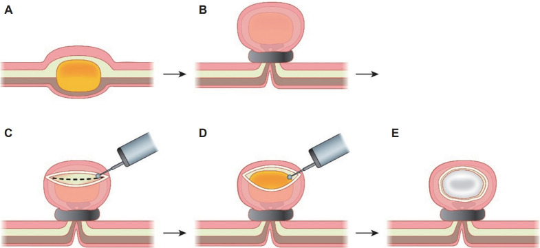 Recent Advances in Endoscopic Treatment Techniques for Subepithelial Lesions.