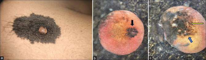 Neuroid Overgrowth Proliferative Nodule in Congenital Melanocytic Nevus: A Rare Occurrence.
