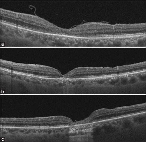 Comparison of superior and temporal inverted internal limiting membrane techniques in macular hole surgery: Surgical outcomes and the role of postoperative positioning.