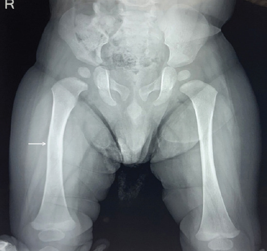 Obstetric Neonatal Femur Fracture During Emergency Cesarean Section for Breech: A Case Report.