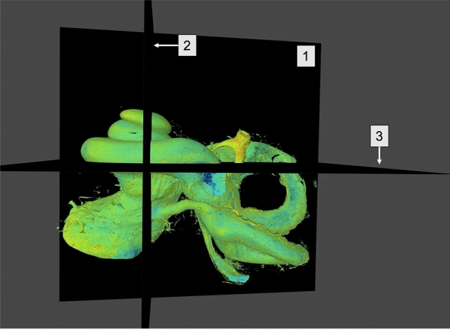 Volume rendering technique and high-resolution microCT: 3D exploration of the cochlear anatomy.