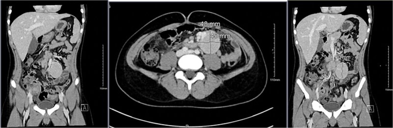 Castleman disease: a case report of a pediatric incidental case in Saudi Arabia.