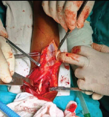 Humeroulnar Bridging Myositis Ossificans Traumatica: A Case Report.