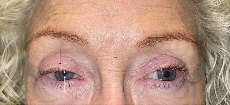 Horner's Syndrome as a Complication After Anterior Cervical Discectomy and Fusion (ACDF) Surgery.