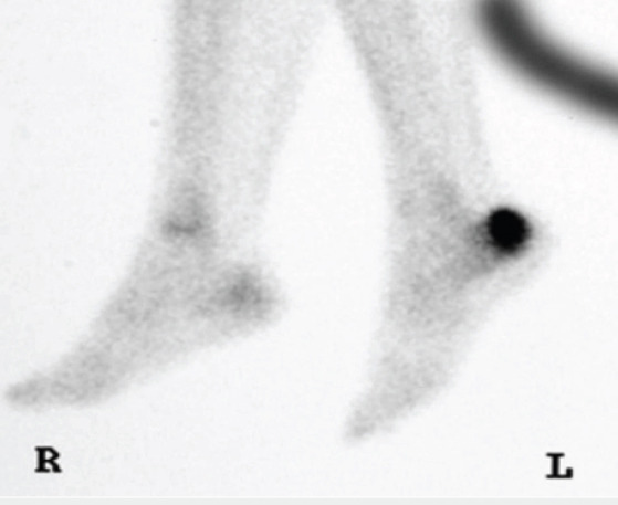 Calcaneus and Traumatic Stress Fracture.