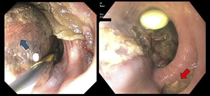 Esophageal Hematoma Following Transcatheter Edge-to-Edge Repair of the Mitral Valve: A Rare Complication of Transesophageal Echocardiography.