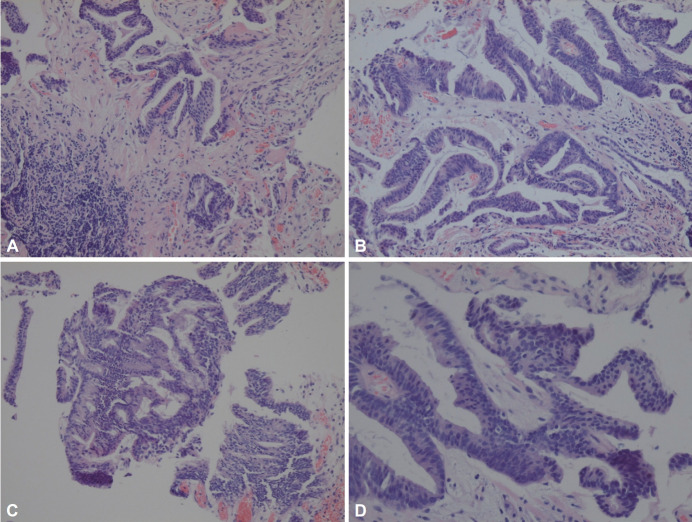 Atypical Gastric Lesion Revealing Underlying Pancreatic Cancer With Direct Invasion.