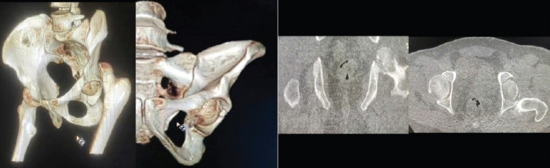 Extraarticular Interfragmentary Fixation of an Irreducible Pipkin Type 1 Fracture Dislocation of the Hip - A Case Report.