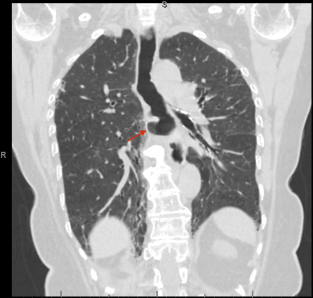 Esophageal Hematoma Following Transcatheter Edge-to-Edge Repair of the Mitral Valve: A Rare Complication of Transesophageal Echocardiography.