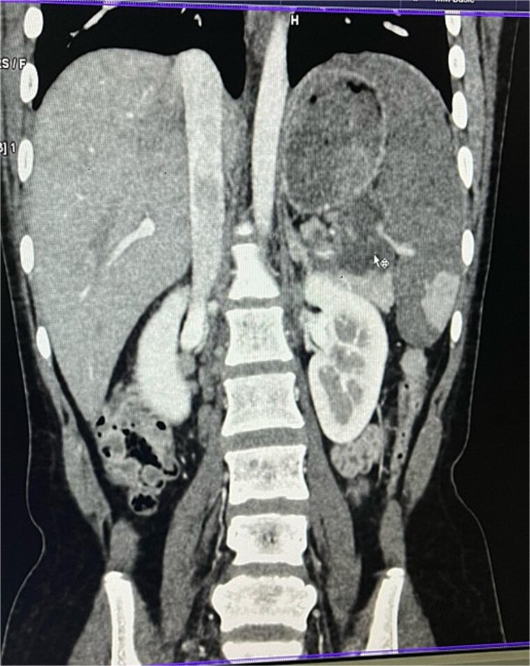 Isolated pancreatic tail and splenic hilum tuberculosis: a rare case report.