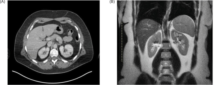 Partial Nephrectomy as Management of Oligometastatic Cancer with Limited Systemic Treatment Options: A Case Report.
