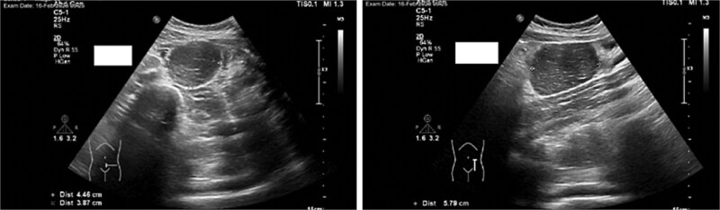Castleman disease: a case report of a pediatric incidental case in Saudi Arabia.
