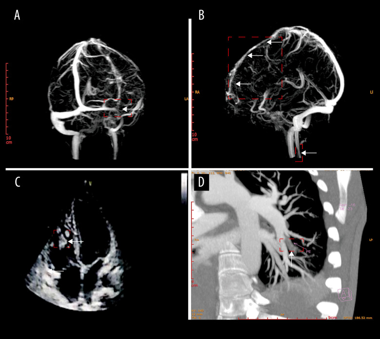 Thrombotic Challenges at High Altitude: A Case Report of Cerebral, Pulmonary, and Ventricular Thrombosis in a 21-Year-Old.
