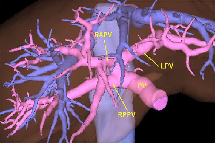 A case of the left medial sectional bile duct joining the right hepatic duct.