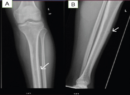 Diagnostic Pitfalls: Anterior Tibial Stress Fracture in a Professional Football Player - A Case Report.